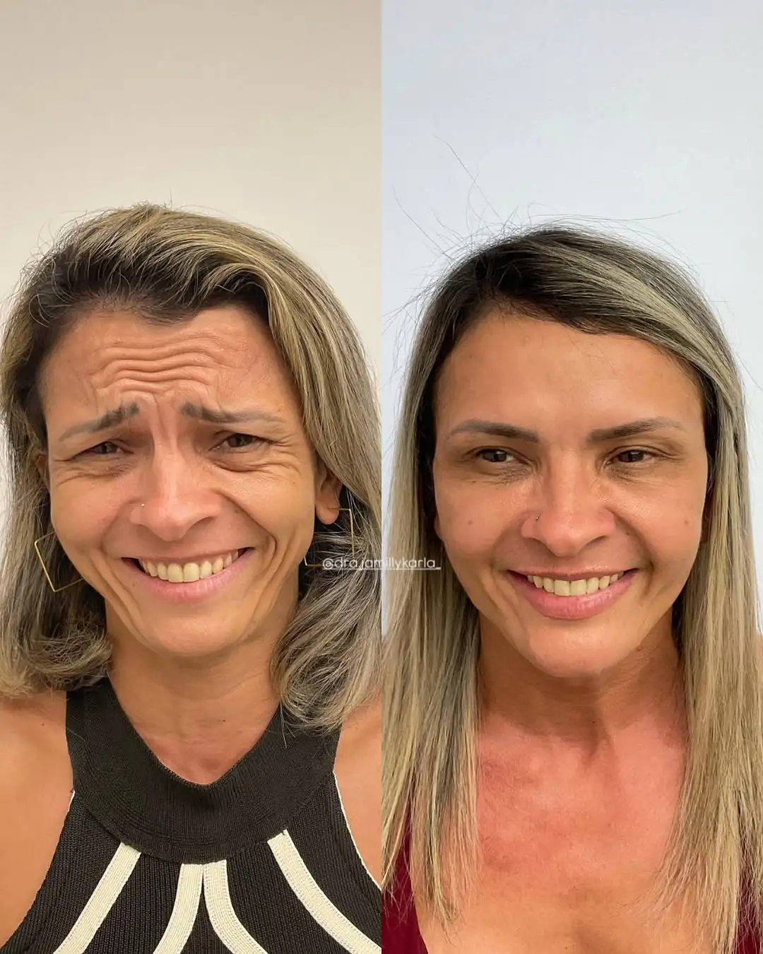 Resultado 1 de harmonização facial pela Dra. Jamilly Karla em Santa Rita e João Pessoa