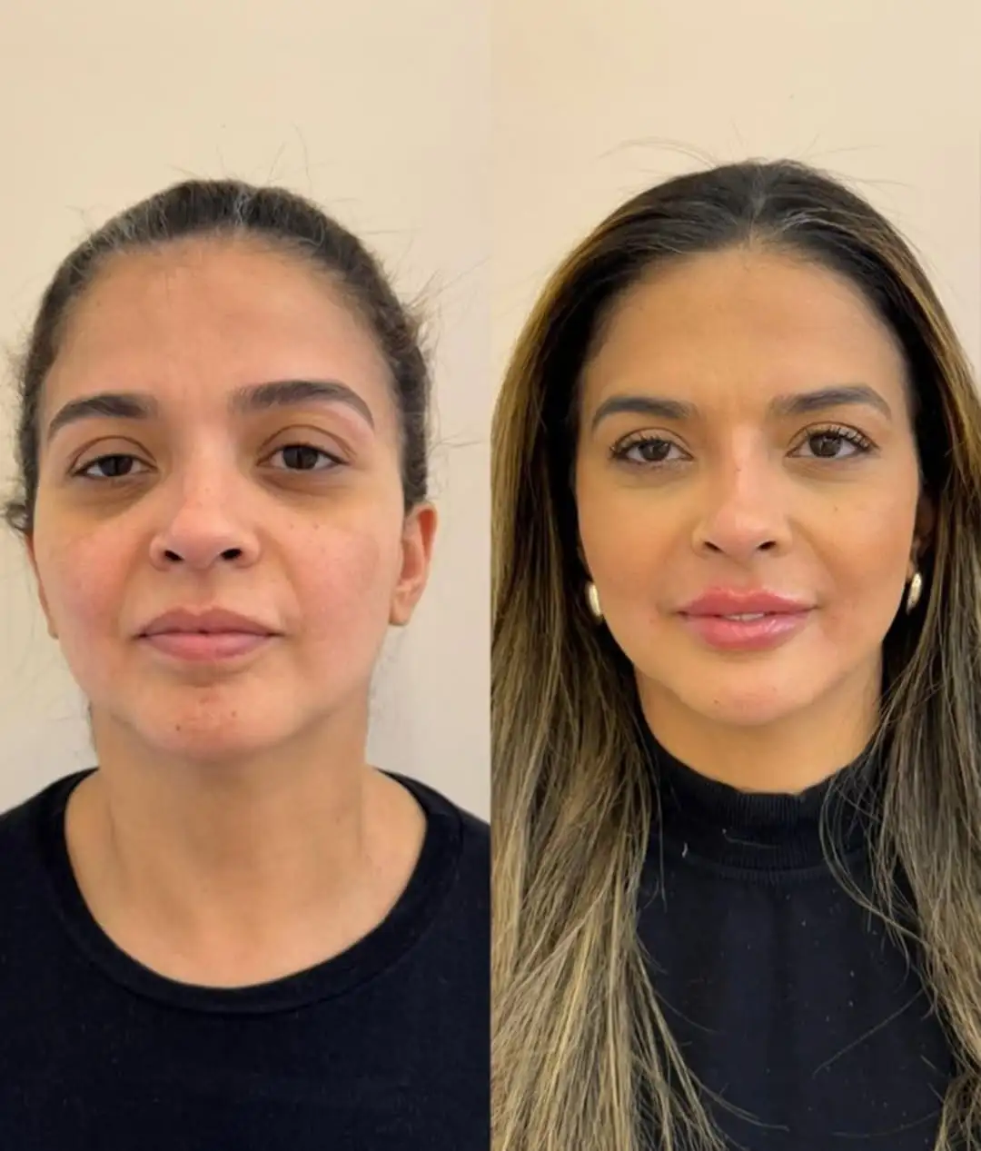 Resultado 2 de harmonização facial pela Dra. Jamilly Karla em Santa Rita e João Pessoa