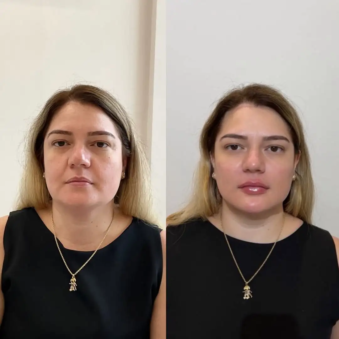 Resultado 4 de harmonização facial pela Dra. Jamilly Karla em Santa Rita e João Pessoa