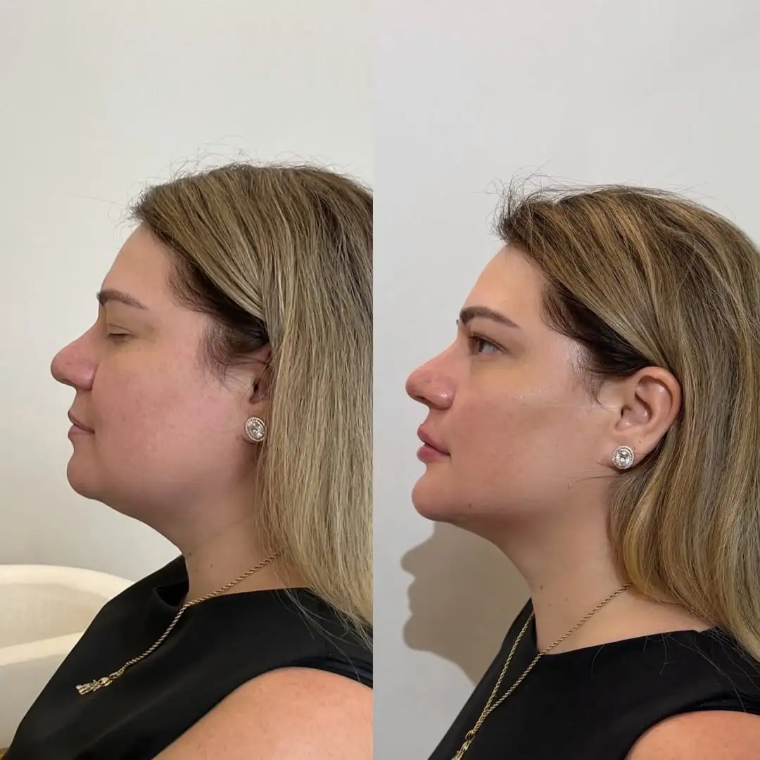 Resultado 3 de harmonização facial pela Dra. Jamilly Karla em Santa Rita e João Pessoa